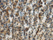 MICA Antibody - Immunohistochemistry of paraffin-embedded Human liver cancer tissue  using MICA Polyclonal Antibody at dilution of 1:60(×200)