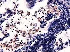 MICAL1 / MICAL Antibody - Immunohistochemical staining of paraffin-embedded Carcinoma of Human lung tissue using anti-MICAL1 mouse monoclonal antibody.