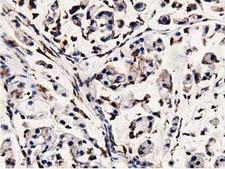 MICAL1 / MICAL Antibody - IHC of paraffin-embedded Adenocarcinoma of Human colon tissue using anti-MICAL1 mouse monoclonal antibody.