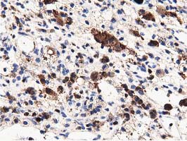 MICAL1 / MICAL Antibody - IHC of paraffin-embedded Carcinoma of Human kidney tissue using anti-MICAL1 mouse monoclonal antibody.