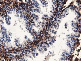 MICAL1 / MICAL Antibody - IHC of paraffin-embedded Carcinoma of Human prostate tissue using anti-MICAL1 mouse monoclonal antibody.