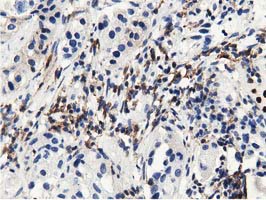 MICAL1 / MICAL Antibody - IHC of paraffin-embedded Carcinoma of Human bladder tissue using anti-MICAL1 mouse monoclonal antibody.