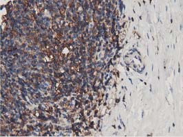 MICAL1 / MICAL Antibody - IHC of paraffin-embedded Human lymphoma tissue using anti-MICAL1 mouse monoclonal antibody.