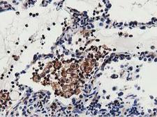MICAL1 / MICAL Antibody - IHC of paraffin-embedded Carcinoma of Human lung tissue using anti-MICAL1 mouse monoclonal antibody.