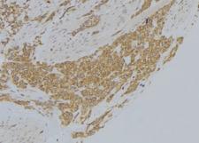 MICAL1 / MICAL Antibody - 1:100 staining human lung tissue by IHC-P. The sample was formaldehyde fixed and a heat mediated antigen retrieval step in citrate buffer was performed. The sample was then blocked and incubated with the antibody for 1.5 hours at 22°C. An HRP conjugated goat anti-rabbit antibody was used as the secondary.