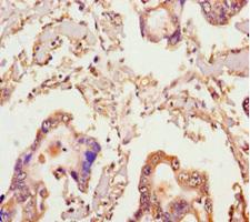 MICAL2 Antibody - Immunohistochemistry of paraffin-embedded human pancreatic cancer using MICAL2 Antibody at dilution of 1:100