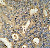 MICALL1 / MICAL-L1 Antibody - MICALL1 Antibody immunohistochemistry of formalin-fixed and paraffin-embedded human prostate carcinoma followed by peroxidase-conjugated secondary antibody and DAB staining.