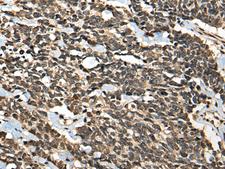 MICU1 / CBARA1 Antibody - Immunohistochemistry of paraffin-embedded Human lung cancer tissue  using MICU1 Polyclonal Antibody at dilution of 1:35(×200)