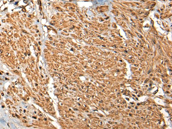 MICU1 / CBARA1 Antibody - Immunohistochemistry of paraffin-embedded Human prost ate cancer tissue  using MICU1 Polyclonal Antibody at dilution of 1:35(×200)