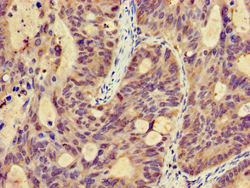 MICU2 / EFHA1 Antibody - Immunohistochemistry image of paraffin-embedded human colon cancer at a dilution of 1:100