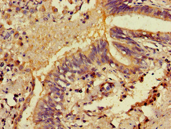 MICU2 / EFHA1 Antibody - Immunohistochemistry image of paraffin-embedded human lung cancer at a dilution of 1:100