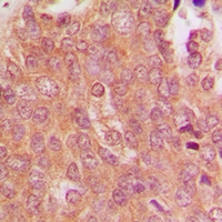 MID1 Antibody - Immunohistochemical analysis of MID1 staining in human breast cancer formalin fixed paraffin embedded tissue section. The section was pre-treated using heat mediated antigen retrieval with sodium citrate buffer (pH 6.0). The section was then incubated with the antibody at room temperature and detected using an HRP polymer system. DAB was used as the chromogen. The section was then counterstained with hematoxylin and mounted with DPX.