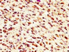 MID1IP1 Antibody - Immunohistochemistry image at a dilution of 1:300 and staining in paraffin-embedded human glioma cancer performed on a Leica BondTM system. After dewaxing and hydration, antigen retrieval was mediated by high pressure in a citrate buffer (pH 6.0) . Section was blocked with 10% normal goat serum 30min at RT. Then primary antibody (1% BSA) was incubated at 4 °C overnight. The primary is detected by a biotinylated secondary antibody and visualized using an HRP conjugated SP system.