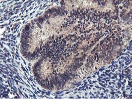 MIER2 Antibody - IHC of paraffin-embedded Adenocarcinoma of Human endometrium tissue using anti-MIER2 mouse monoclonal antibody. (Heat-induced epitope retrieval by 10mM citric buffer, pH6.0, 100C for 10min).