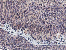 MIER2 Antibody - IHC of paraffin-embedded Carcinoma of Human bladder tissue using anti-MIER2 mouse monoclonal antibody. (Heat-induced epitope retrieval by 10mM citric buffer, pH6.0, 100C for 10min).