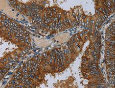 MIER2 Antibody - Immunohistochemistry of paraffin-embedded Human colon cancer using MIER2 Polyclonal Antibody at dilution of 1:50.