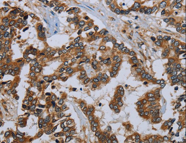 MIER2 Antibody - Immunohistochemistry of paraffin-embedded Human liver cancer using MIER2 Polyclonal Antibody at dilution of 1:50.