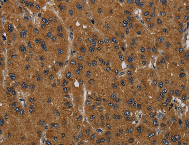 MIER2 Antibody - Immunohistochemistry of paraffin-embedded Human liver cancer using MIER2 Polyclonal Antibody at dilution of 1:60.