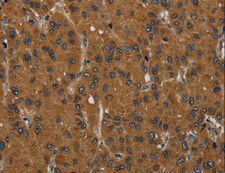 MIER2 Antibody - Immunohistochemistry of paraffin-embedded Human liver cancer using MIER2 Polyclonal Antibody at dilution of 1:60.