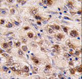 MINA / MINA53 Antibody - Formalin-fixed and paraffin-embedded human hepatocarcinoma tissue reacted with MINA , which was peroxidase-conjugated to the secondary antibody, followed by DAB staining. This data demonstrates the use of this antibody for immunohistochemistry; clinical relevance has not been evaluated.