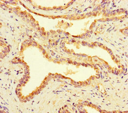 MINA / MINA53 Antibody - Immunohistochemistry of paraffin-embedded human prostate cancer using MINA Antibody at dilution of 1:100