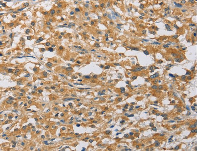 MIP / AQP0 / Aquaporin 0 Antibody - Immunohistochemistry of paraffin-embedded Human thyroid cancer using MIP Polyclonal Antibody at dilution of 1:60.