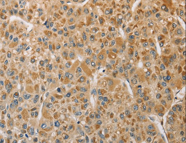 MIP / AQP0 / Aquaporin 0 Antibody - Immunohistochemistry of paraffin-embedded Human gastric cancer using MIP Polyclonal Antibody at dilution of 1:50.