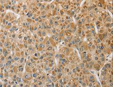 MIP / AQP0 / Aquaporin 0 Antibody - Immunohistochemistry of paraffin-embedded Human gastric cancer using MIP Polyclonal Antibody at dilution of 1:50.