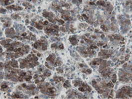 MIPEP Antibody - IHC of paraffin-embedded Carcinoma of Human liver tissue using anti-MIPEP mouse monoclonal antibody.