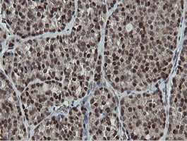 MIPEP Antibody - IHC of paraffin-embedded Carcinoma of Human thyroid tissue using anti-MIPEP mouse monoclonal antibody.