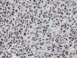 MIPEP Antibody - IHC of paraffin-embedded Carcinoma of Human bladder tissue using anti-MIPEP mouse monoclonal antibody.
