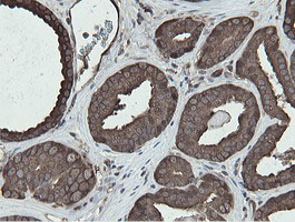 MIPEP Antibody - IHC of paraffin-embedded Carcinoma of Human prostate tissue using anti-MIPEP mouse monoclonal antibody.