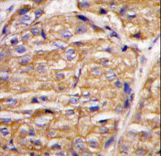 MIPEP Antibody - Formalin-fixed and paraffin-embedded human breast carcinoma tissue reacted with MIPEP antibody , which was peroxidase-conjugated to the secondary antibody, followed by DAB staining. This data demonstrates the use of this antibody for immunohistochemistry; clinical relevance has not been evaluated.