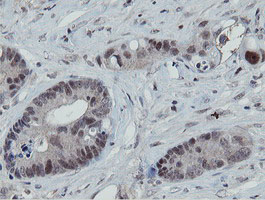 MIPEP Antibody - IHC of paraffin-embedded Adenocarcinoma of Human colon tissue using anti-MIPEP mouse monoclonal antibody.