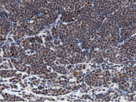 MIPEP Antibody - IHC of paraffin-embedded Human lymphoma tissue using anti-MIPEP mouse monoclonal antibody.
