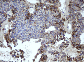 MIPEP Antibody - IHC of paraffin-embedded Carcinoma of Human pancreas tissue using anti-MIPEP mouse monoclonal antibody.