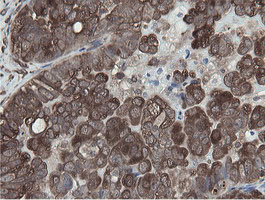 MIPEP Antibody - IHC of paraffin-embedded Adenocarcinoma of Human ovary tissue using anti-MIPEP mouse monoclonal antibody.