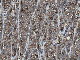 MIPEP Antibody - IHC of paraffin-embedded Carcinoma of Human thyroid tissue using anti-MIPEP mouse monoclonal antibody.