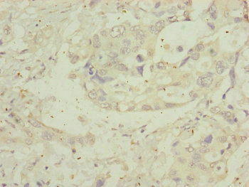 MIPEP Antibody - Immunohistochemistry of paraffin-embedded human pancreatic cancer at dilution of 1:100