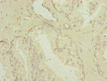 MIPEP Antibody - Immunohistochemistry of paraffin-embedded human prostate cancer at dilution of 1:100