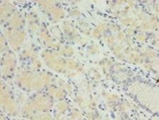 MIS12 Antibody - Immunohistochemistry of paraffin-embedded human gastric cancer using antibody at 1:100 dilution.  This image was taken for the unconjugated form of this product. Other forms have not been tested.