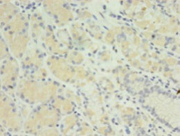 MIS12 Antibody - Immunohistochemistry of paraffin-embedded human gastric cancer using MIS12 Antibody at dilution of 1:100