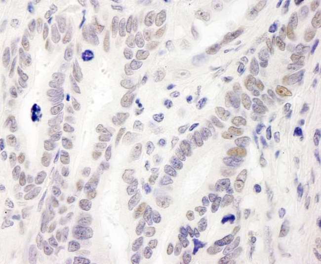 MIS12 Antibody - Detection of Human MIS12 by Immunohistochemistry. Sample: FFPE section of human stomach carcinoma. Antibody: Affinity purified rabbit anti-MIS12 used at a dilution of 1:1000 (1 Detection: DAB.
