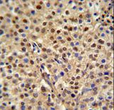 MISP / C19orf21 Antibody - C19orf21 Antibody IHC of formalin-fixed and paraffin-embedded human cervix carcinoma followed by peroxidase-conjugated secondary antibody and DAB staining.