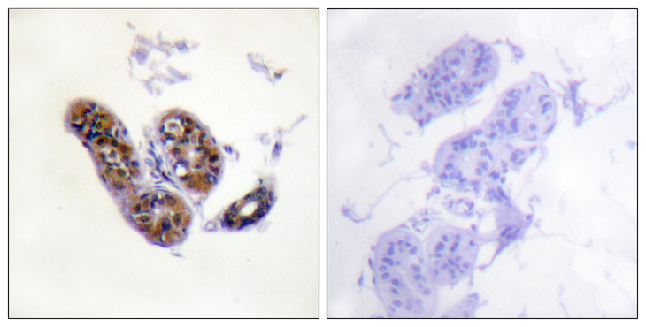 MITF Antibody - Immunohistochemistry analysis of paraffin-embedded human skin tissue, using MITF Antibody. The picture on the right is blocked with the synthesized peptide.