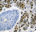 MITF Antibody - IHC of MiTF on FFPE Melanoma tissue. This image was taken for the unmodified form of this product. Other forms have not been tested.