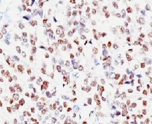 MITF Antibody - Formalin-fixed, paraffin-embedded human melanoma stained with MITF antibody (MITF/915).  This image was taken for the unmodified form of this product. Other forms have not been tested.