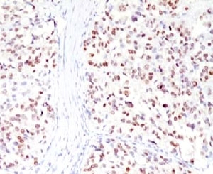 MITF Antibody - IHC testing of FFPE human melanoma with MITF antibody (clone MPAF3).  This image was taken for the unmodified form of this product. Other forms have not been tested.