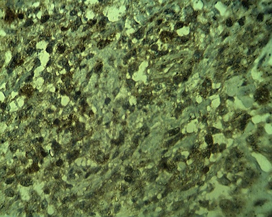 MITF Antibody - IHC of human melanoma tumor using MiTF polyclonal antibody at 10 ug/ml.