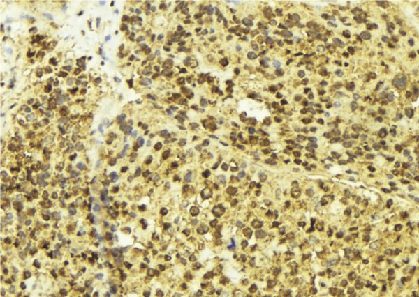 MITF Antibody - 1:100 staining human breast carcinoma tissue by IHC-P. The sample was formaldehyde fixed and a heat mediated antigen retrieval step in citrate buffer was performed. The sample was then blocked and incubated with the antibody for 1.5 hours at 22°C. An HRP conjugated goat anti-rabbit antibody was used as the secondary.